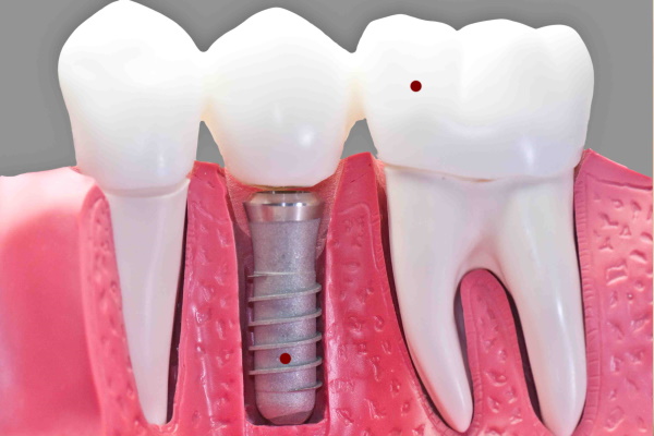 implantes dentales en toluca y metepec panoramika